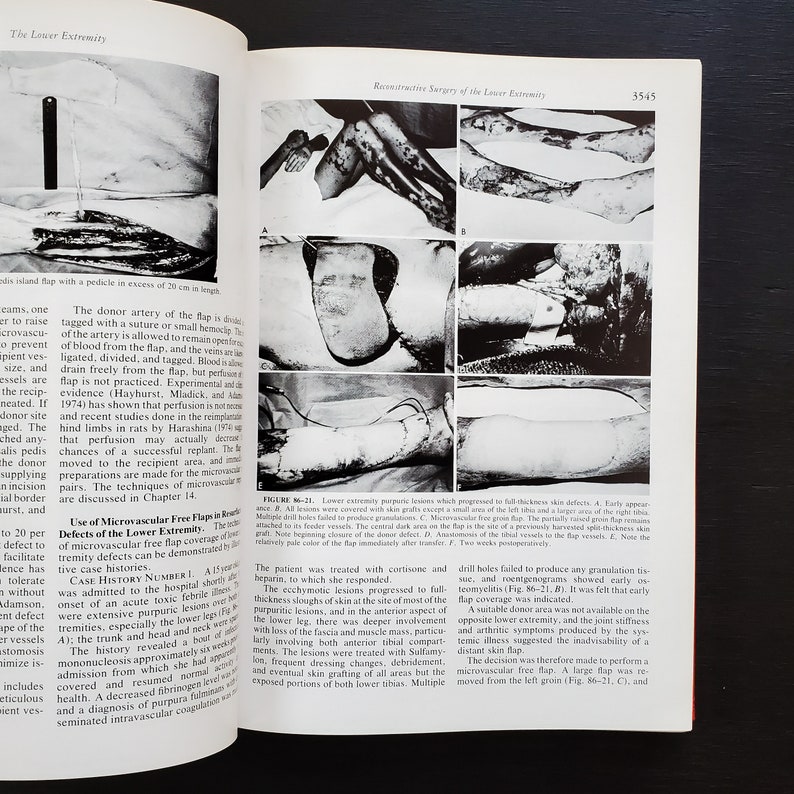 May include: A black and white medical textbook page with images of a lower leg with skin grafts. The text on the page discusses the use of microvascular free flaps in reconstructive surgery of the lower extremity.
