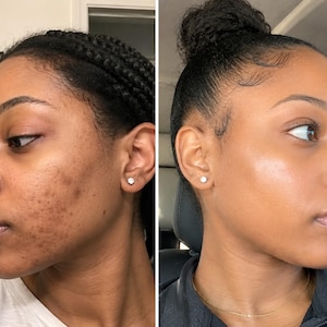 Puede incluir: Una comparaci&oacute;n lado a lado que muestra una vista de perfil de un rostro con manchas oscuras y textura de piel visible a la izquierda, contrastada con una vista de perfil del mismo rostro que muestra un tono y textura de piel m&aacute;s suaves y uniformes a la derecha.