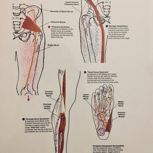 Peripheral Entrapment Neurapathy Poster Set