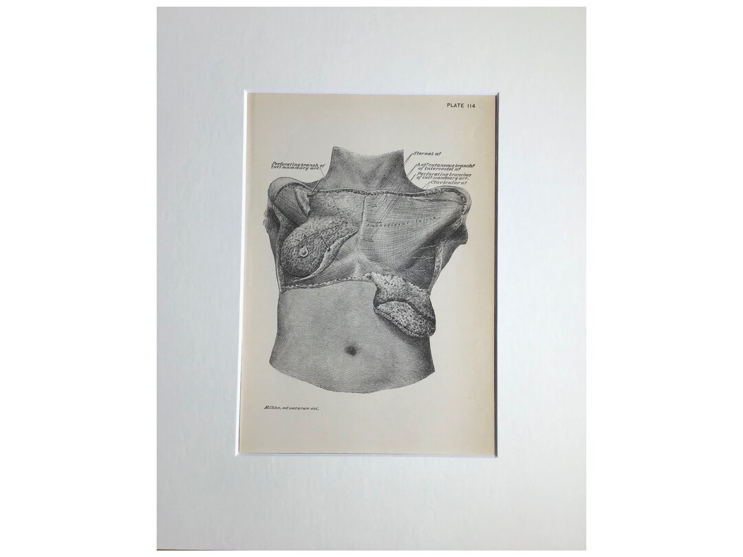 Anatomy Print, 1888 NYC, Autopsy Print, Antique Print, Dissection Print ...