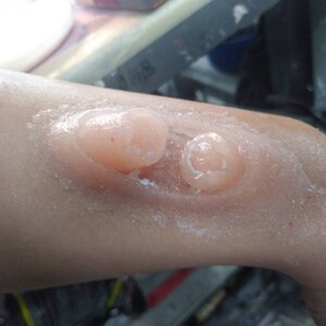 May include: Close-up of a person's arm with two large, round, flesh-colored bumps. The bumps are covered in a white, powdery substance.