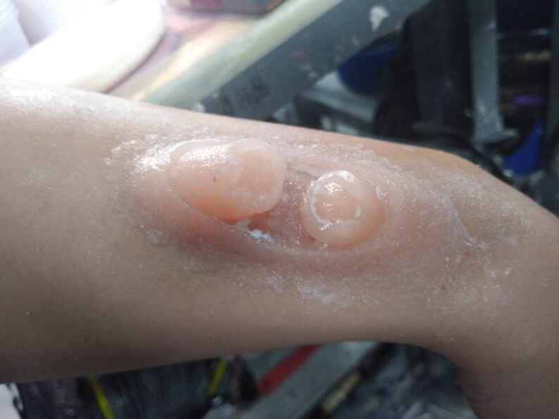 May include: Close-up of a person's arm with two large, round, flesh-colored bumps. The bumps are covered in a white, powdery substance.