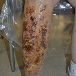 May include: A close-up of a person's lower leg with a large, brown, and red burn scar. The scar covers most of the lower leg and is surrounded by healthy skin.