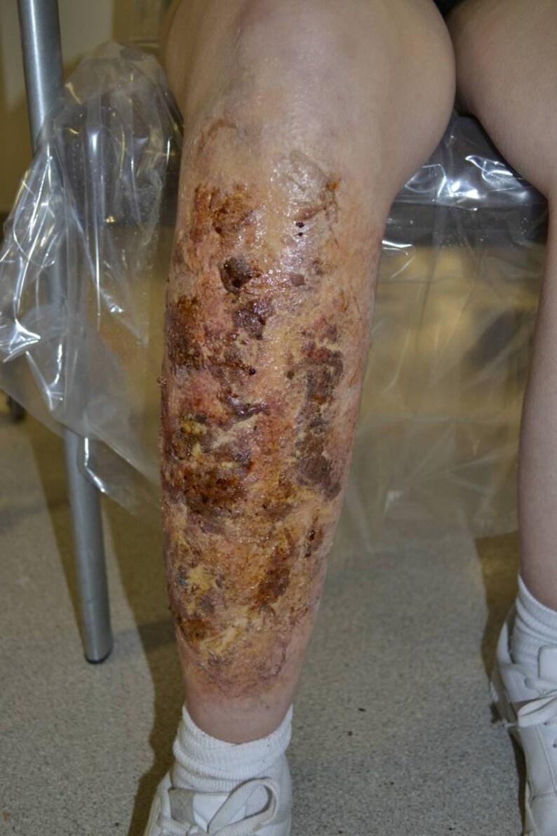 May include: A close-up of a person's lower leg with a large, brown, and red burn scar. The scar covers most of the lower leg and is surrounded by healthy skin.
