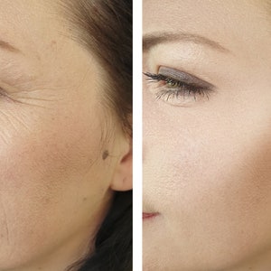 May include: A before and after photo demonstrating the results of a beauty treatment on a person's face. The left side of the image shows wrinkles around the eye area. The right side of the image shows smoother skin with fewer wrinkles.