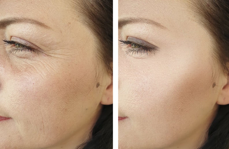 May include: A before and after photo demonstrating the results of a beauty treatment on a person's face. The left side of the image shows wrinkles around the eye area. The right side of the image shows smoother skin with fewer wrinkles.