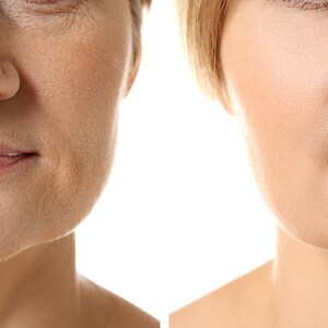 May include: Before and after photographs illustrating the results of a cosmetic procedure on a person's face. The left image shows wrinkles and sagging skin around the mouth and jawline. The right image shows smoother skin with less noticeable wrinkles.