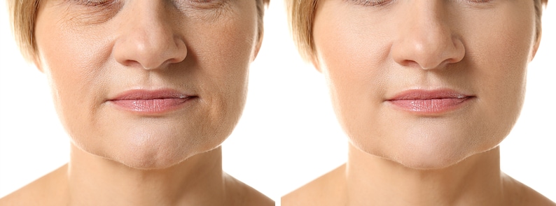 May include: Before and after photographs illustrating the results of a cosmetic procedure on a person's face. The left image shows wrinkles and sagging skin around the mouth and jawline. The right image shows smoother skin with less noticeable wrinkles.