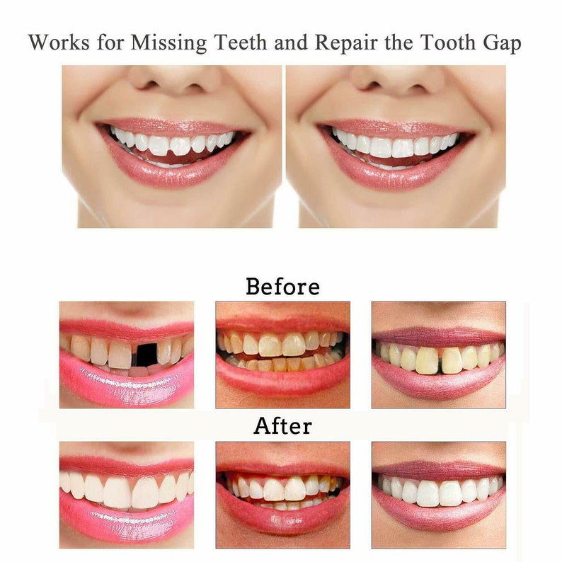 Instant Smile Select A Tooth Temporary Tooth Replacement Kit Etsy