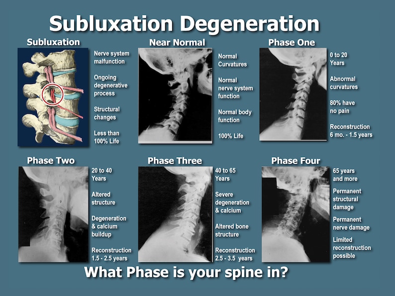 Chiropractic Subluxation Degeneration Poster chiropractic Etsy