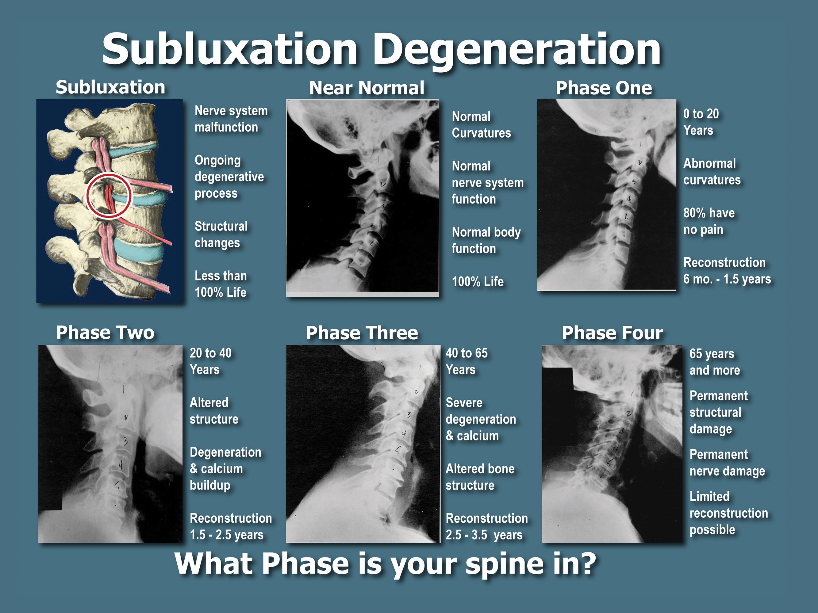Chiropractic Subluxation Degeneration Poster, Chiropractic Wall Art
