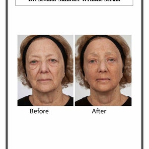 May include: Before and after photos showing the results of using Dr. Sevinor Skincare Wrinkle Serum. The photos show a woman's face, with the before photo showing wrinkles around the eyes and mouth, and the after photo showing smoother skin.