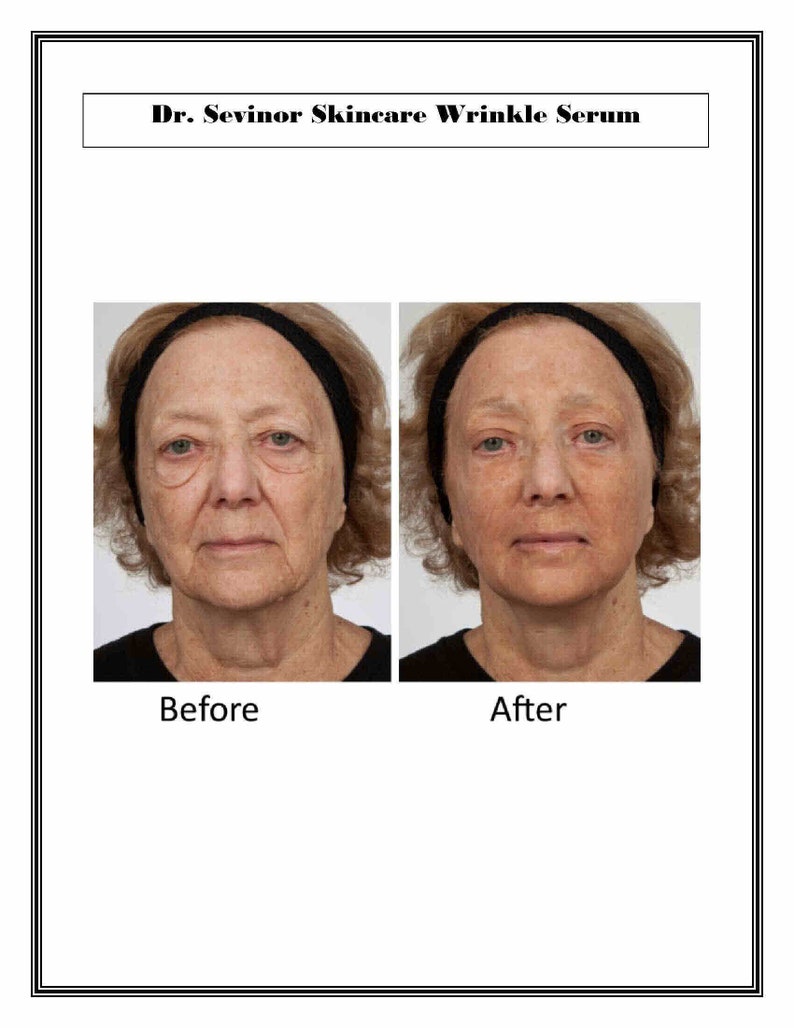 May include: Before and after photos showing the results of using Dr. Sevinor Skincare Wrinkle Serum. The photos show a woman's face, with the before photo showing wrinkles around the eyes and mouth, and the after photo showing smoother skin.