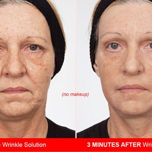 May include: Before and after photos showing the effects of a wrinkle solution. The image on the left shows a woman's face with wrinkles, and the image on the right shows the same woman's face with fewer wrinkles after using the wrinkle solution. The text on the image reads "Before Wrinkle Solution" and "3 MINUTES AFTER Wrinkle Solution".