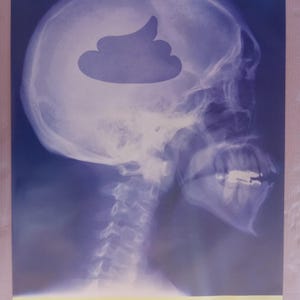 以下が含まれることがあります： 人間の頭蓋骨のレントゲン写真に、うんちの絵文字が重ねられたポスター。下部のテキストは「YOUR PROBLEM IS OBVIOUS」と書かれています。画像は主に青と白です。