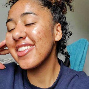May include: A person with curly brown hair smiles with their eyes closed. They are wearing a navy blue Champion sweatshirt. The person's skin has some discoloration. A blue towel is visible in the background.