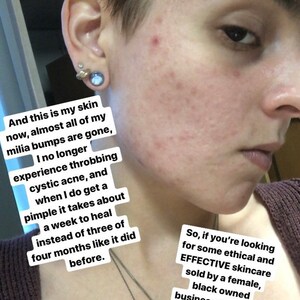 May include: A close-up of a person's face, showing skin with acne and text about skincare. The text mentions milia bumps, cystic acne, and a skincare business. A silver necklace and earrings are also visible.