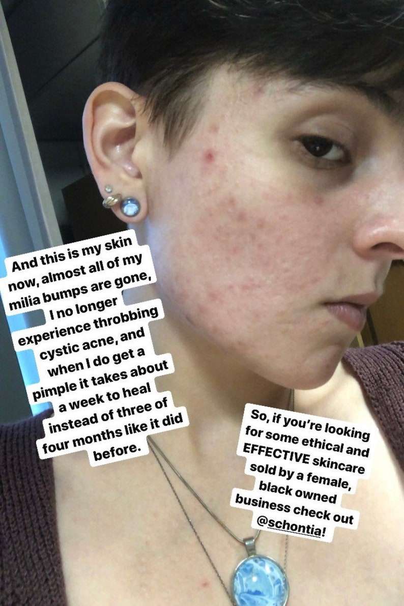 May include: A close-up of a person's face, showing skin with acne and text about skincare. The text mentions milia bumps, cystic acne, and a skincare business. A silver necklace and earrings are also visible.