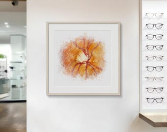 Optic Nerve Cupping Art Print, Glaucoma Eye Art, Ophthalmology Decor - 079