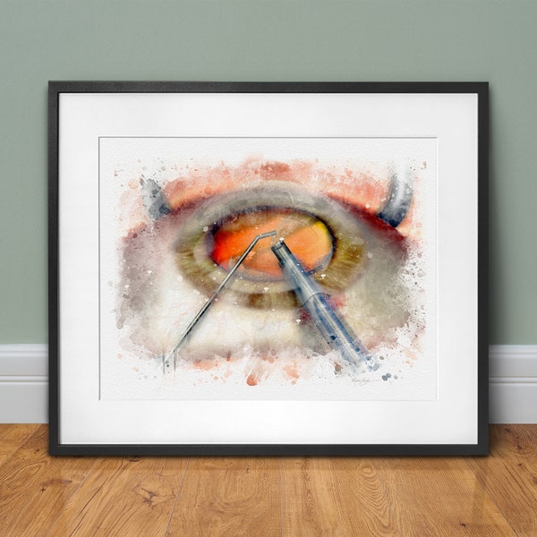 Phaco cataract surgery watercolor style art print for eye doctor office wall, a great gift for eye surgeon eye surgery décor - 160