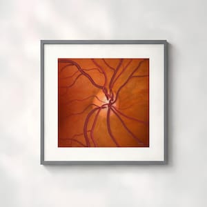 Glaucoma Specialist Gift Optic Nerve Cupping 0.4 C/D Illustration art print, Eye doctor office wall art, Medical student gift - 820