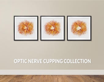 Glaucoma Optic Nerve Cupping Art Print Set, Watercolor-style Eye Art, Eye Doctor Wall Decor