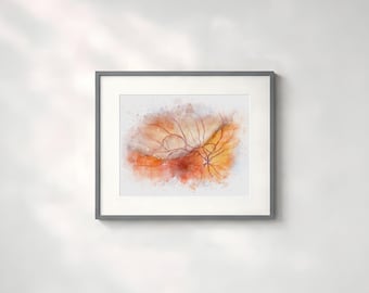Retinal tear and detachment art print for optometrists and ophthalmologists - detailed medical illustration for clinics and offices - 303