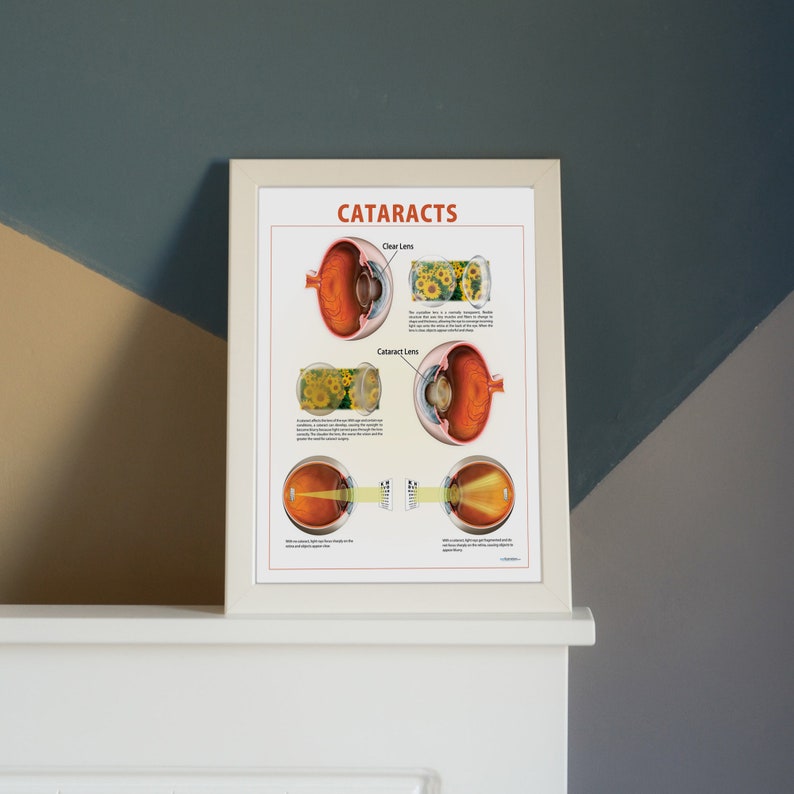 Cataract Poster DIGITAL DOWNLOAD. Eye Doctor Exam Room Instant ...