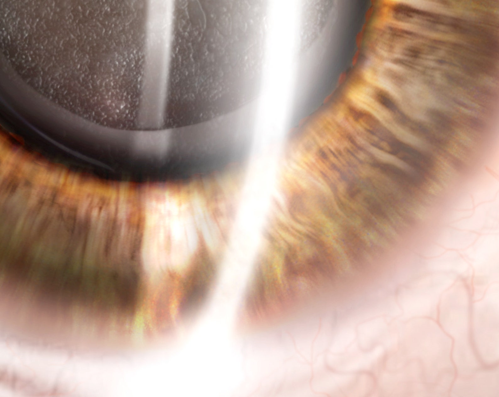 Posterior Capsular Opacification Illustration Fine Art Print Etsy