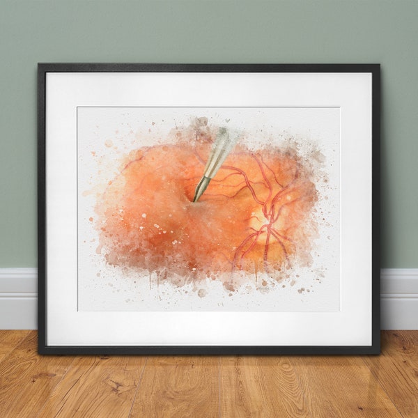 Retina doctor gift, Retina art print, Retina surgery wall décor, Epiretinal membrane peel, retina surgeon gift and eye exam room decor - 239