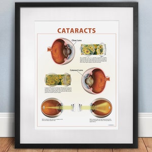 Cataract Poster DIGITAL DOWNLOAD. Eye Doctor Exam Room Instant ...