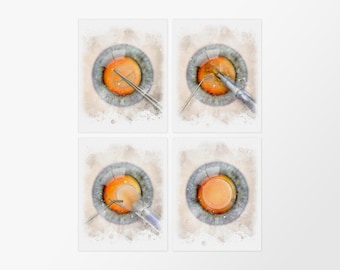 Cataract Surgery Art Set – Watercolor style eye surgical prints for ophthalmology clinic wall decor, all four pieces