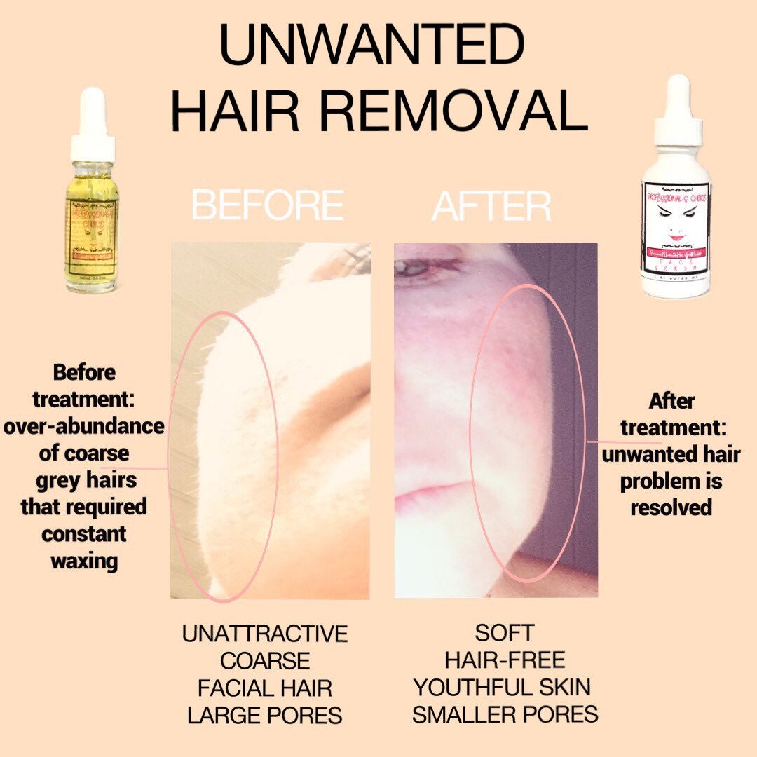 100% Natural Unwanted Hair Removal for Men and Women/hair - Etsy 100% Natural Unwanted Hair Removal for Men and Women/hair - Etsy