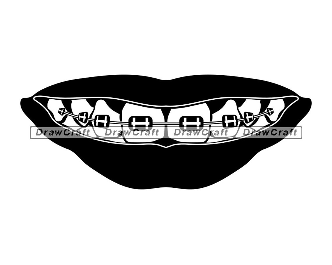 Braces 2 SVG Braces SVG Teeth Svg Teens Svg Dentist Svg | Etsy