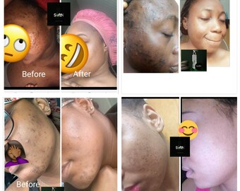 Acne remover  Etsy