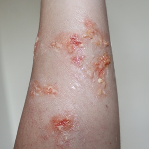 Infected Blisters Boils Prosthetic with Synthetic Burn Pus Gel for Film, Halloween, Special FX and Medical Training by Forensic FX Gore Prop