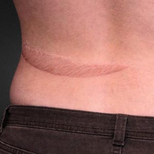 Keloid Scar Silicone Prosthetic - Special Effects Makeup SFX Medical Wound