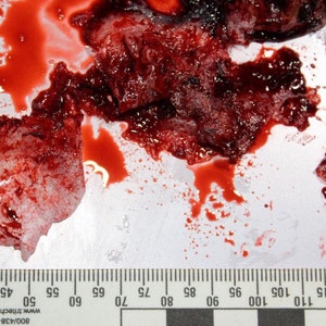 May include: A close-up of a white surface with red blood stains and a white gauze pad. A ruler is visible at the bottom of the image with markings in centimetres.