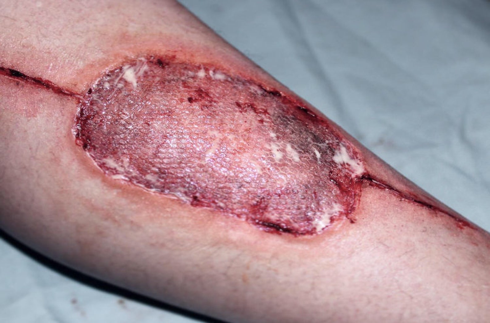 Infected Skin Graft Prosthetic with Synthetic Burn / Infected | Etsy