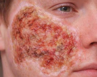 Infected Burn Wound Silicone Prosthetic - Special Effects Makeup  Zombie SFX Fake Injury