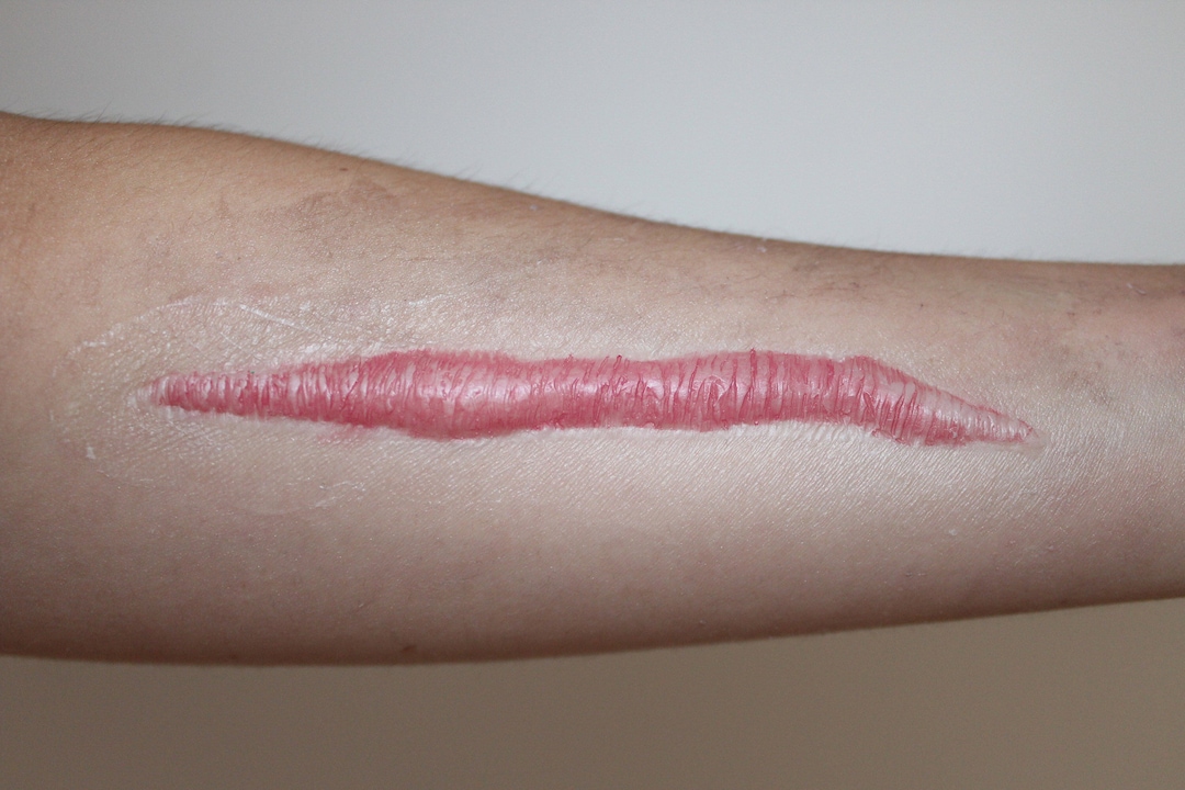 Hyper Realistic Thick Raised Keloid Scar Silicone Prosthetic coloured