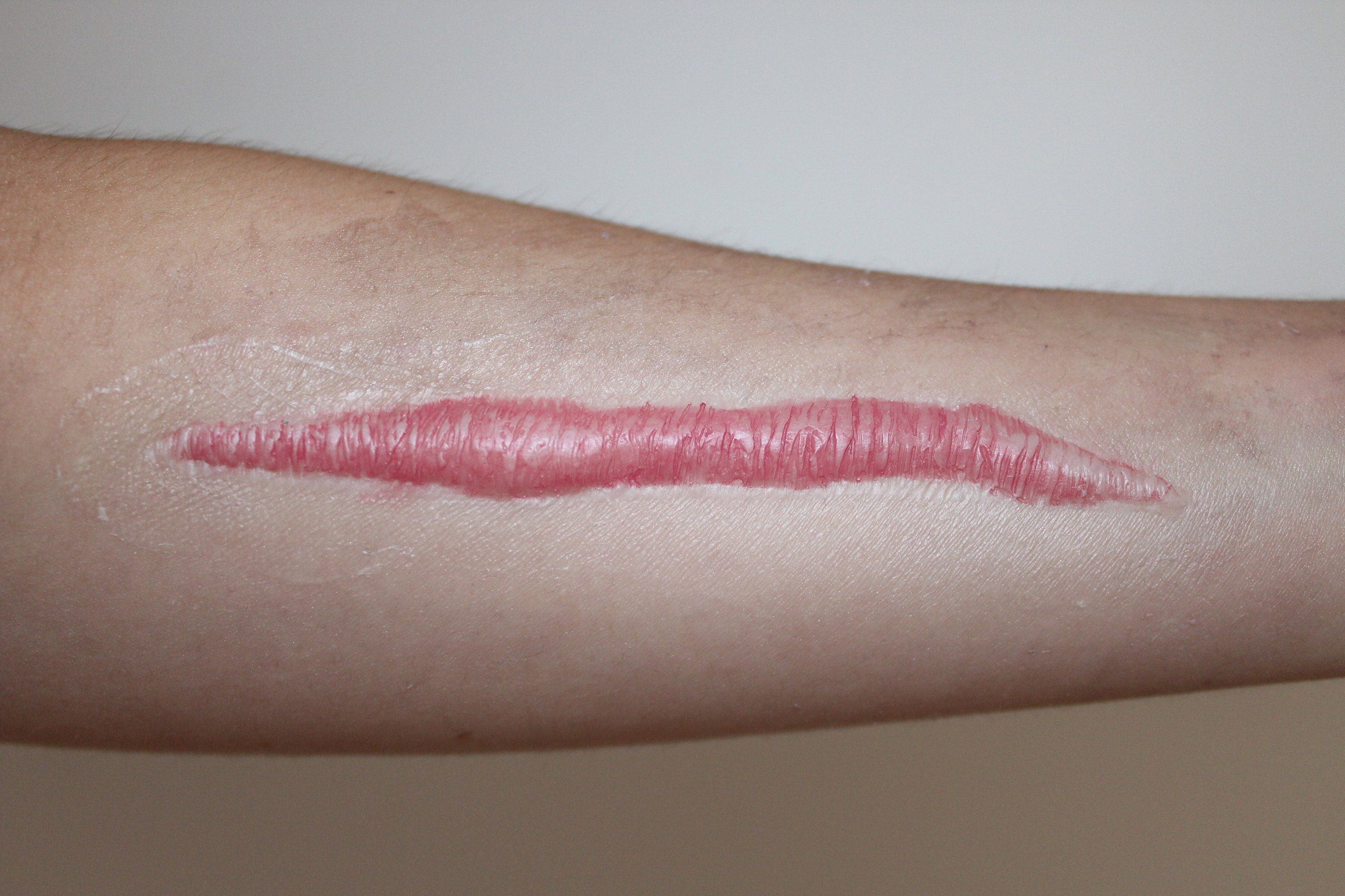 Hyper Realistic Thick Raised Keloid Scar Silicone Prosthetic Etsy