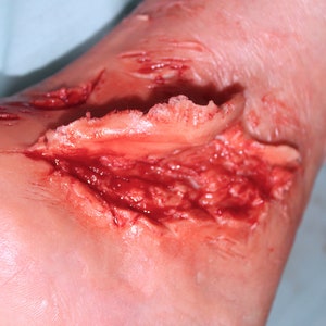 Deep Laceration Wound with Skin Peeling Back Prosthetic for Film, TV, Halloween Costume, Zombie SFX Makeup Medical Training medicine anatomy