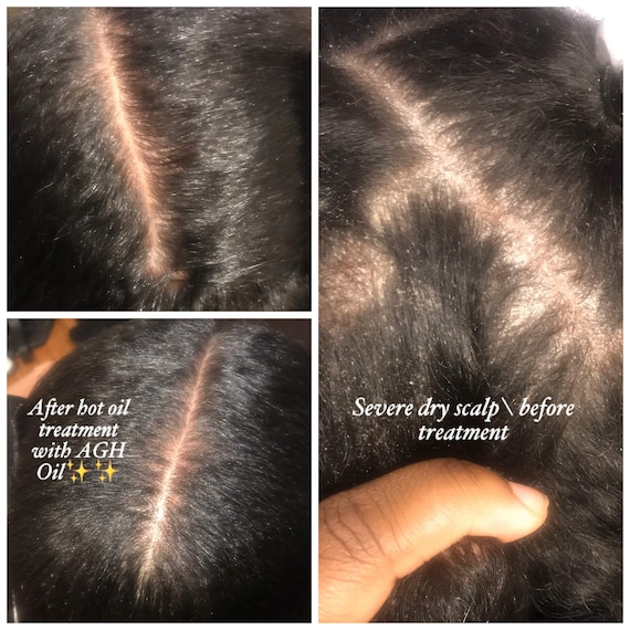 3 Large Natural hair oil for psoriasis and dry flaky scalp | Etsy 3 Large Natural hair oil for psoriasis and dry flaky scalp | Etsy