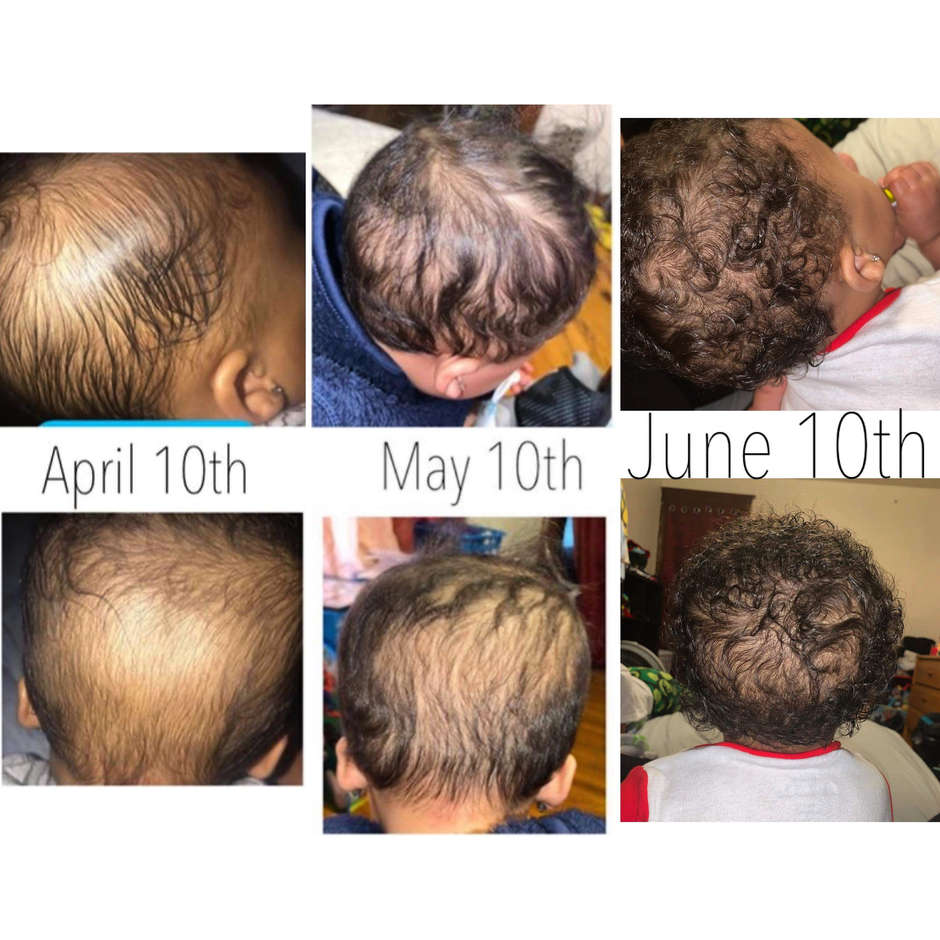 Baby Hair Care Bundle for Cradle Cap Hair Loss Growth and Etsy