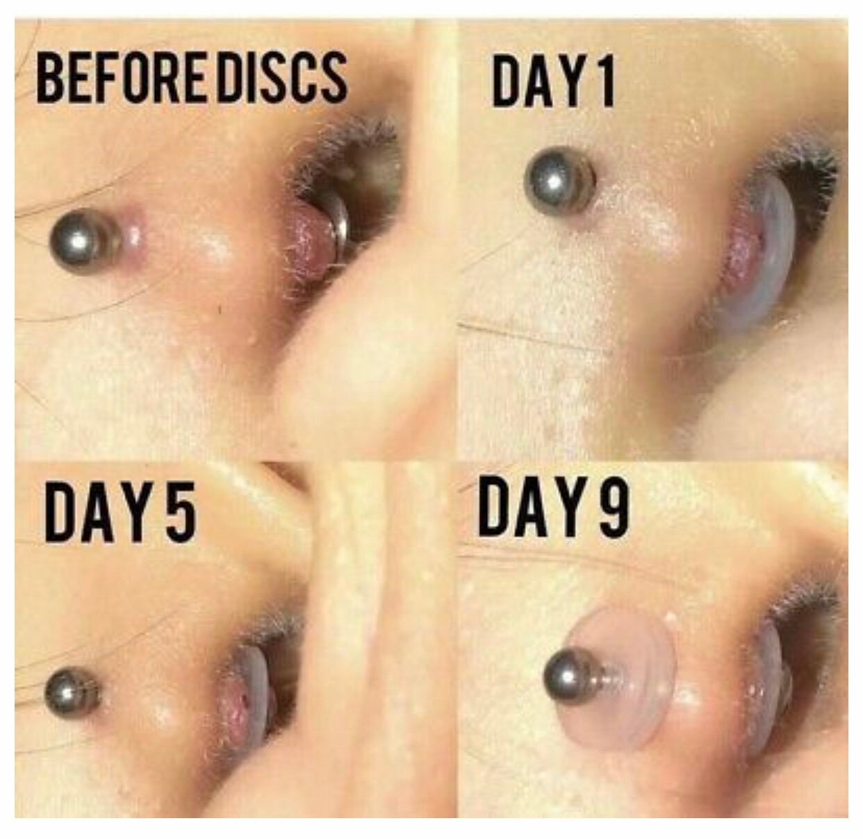 Granuloma En El Piercing Del Ombligo 6 reutilizables NoPull Piercing Disc® Tamaño 7mm 14g - Etsy México