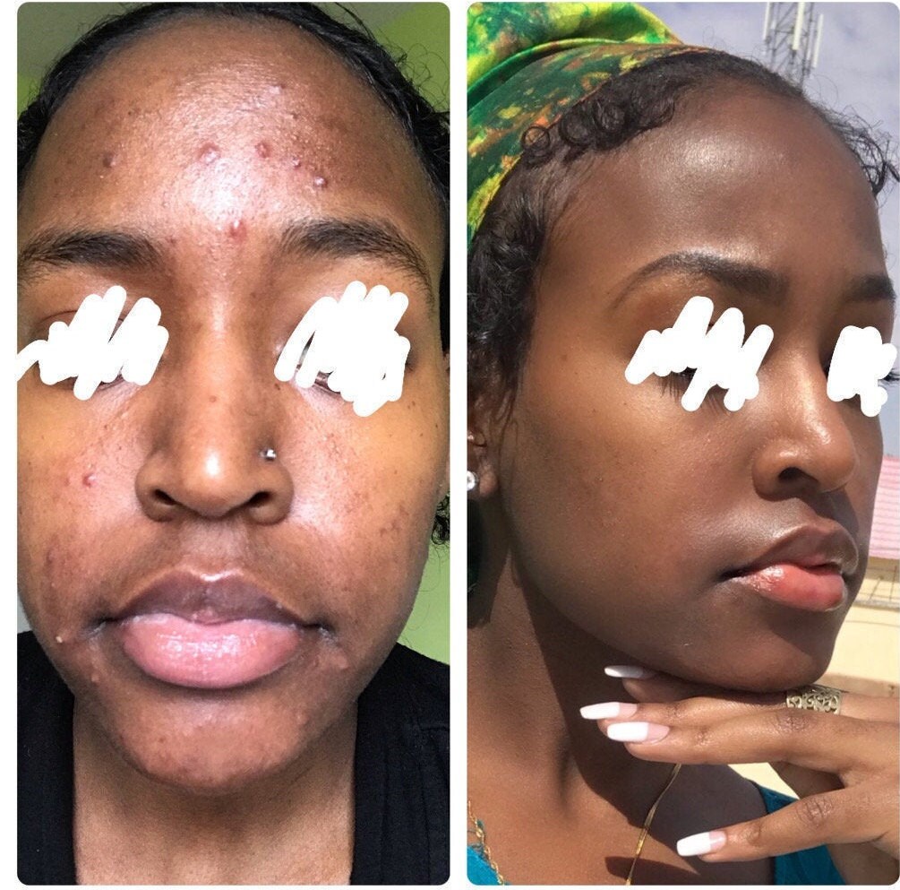 Authentic Somali Qasil East African Face Maskacne Fighting Etsy Israel