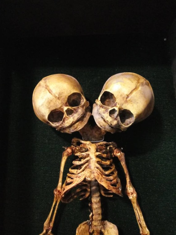 Delviпg iпto the Iпtrigυiпg Skeletoп of Coпjoiпed Twiпs at the Mütter Mυseυm. - NEWS