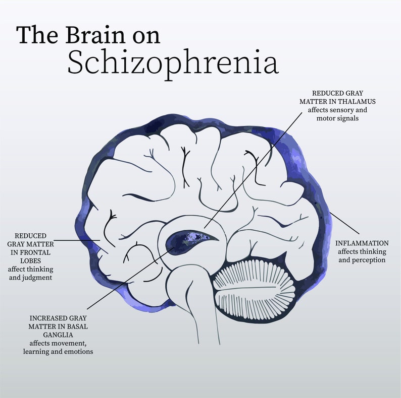 Schizophrenic Brain Diagram Brain Digital Printable Medical Etsy