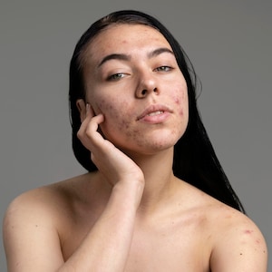 Peut inclure: Portrait rapproch&eacute; d'une personne pr&eacute;sentant de l'acn&eacute; sur le visage et les &eacute;paules. Elle a de longs cheveux noirs et regarde directement la cam&eacute;ra.